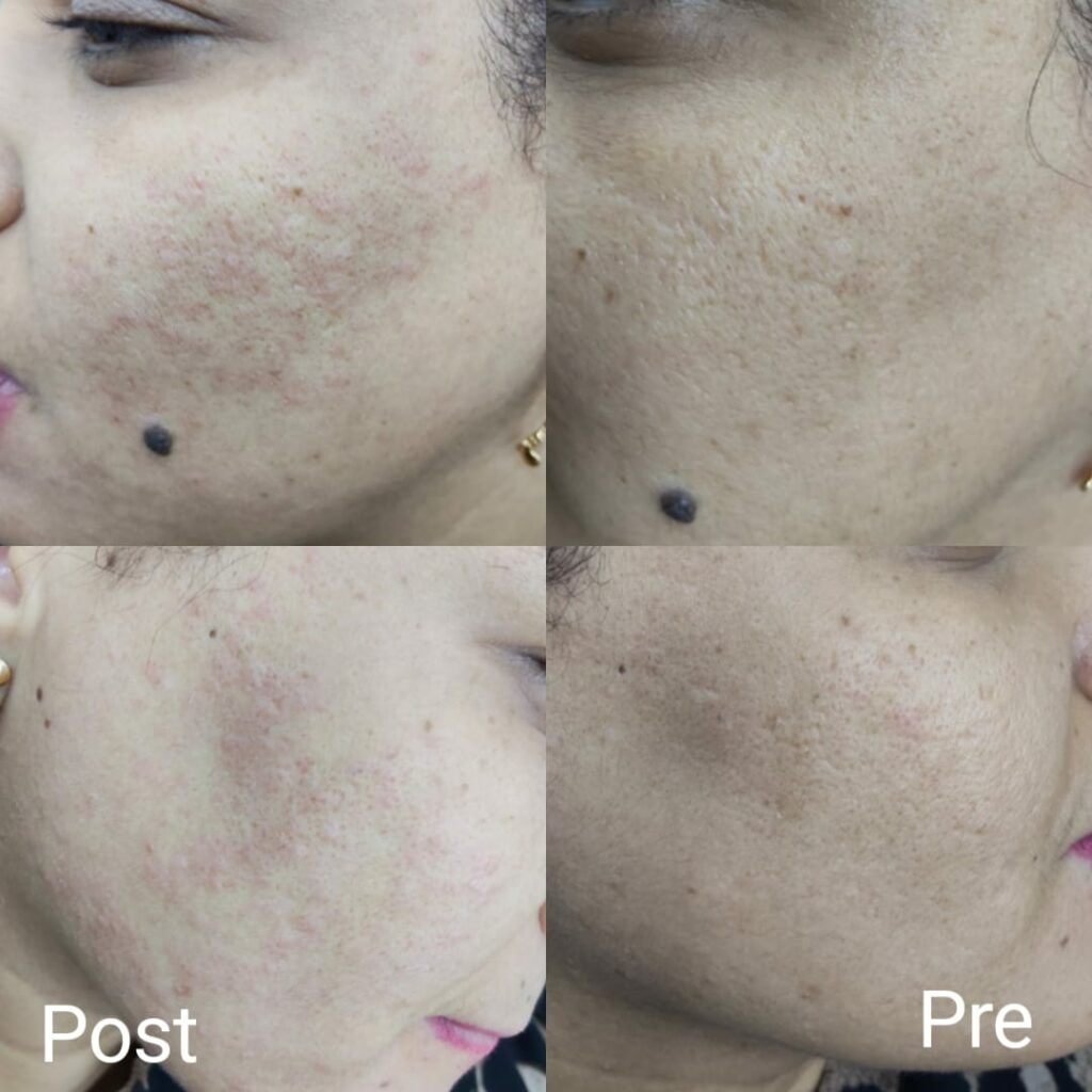 The result of one session to get rid of facial pigmentation